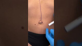 Fixing an Umbilical Hernia