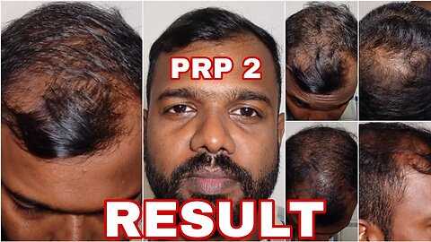 PRP ട്രീറ്റ്മെൻ്റിൻ്റെ ഇഫക്ട് കണ്ടോ സ്വന്തമായി പരീക്ഷിച്ച ഭലം. What is the effect of PRP hair loss