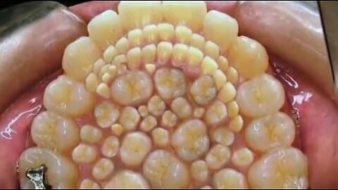 Doctors remove 232 TEETH from boy's MOUTH