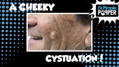 A Cheek Cystuation
