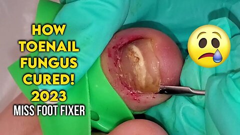 HOW TOENAIL FUNGUS CURED BY REMOVING FUNGAL NAIL FULL PROCEDURE BY FAMOUS PODIATRIST MISS FOOT FIXER