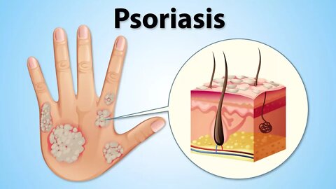 How To Naturally Treat Psoriasis