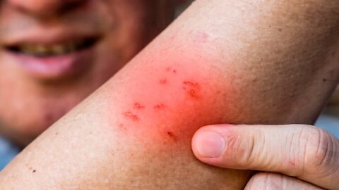 Is Itching Really a Sign of Wound Healing?