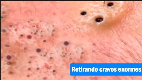 #1 Removing old blackheads and blackheads. satisfying video