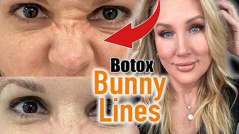 Botox Bunny Lines // Full Tutorial