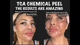 TCA Chemical Peel Amazing Results