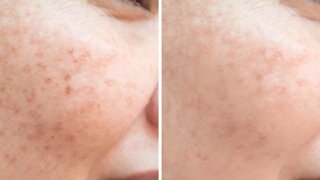 How To Get Rid Of Freckles Naturally