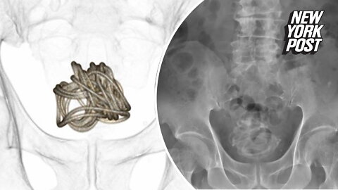 Man gets jump-rope stuck in bladder after shoving it into his penis