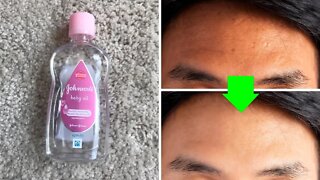 Get Rid of Dark Spots Using Baby Oil