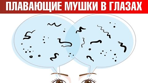 Как избавиться от мушек в глазах? Мушки перед глазами: причины - ДокторБерг