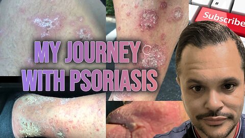 My Journey with Psoriasis: A Year-Long Battle After Moving to Atlanta