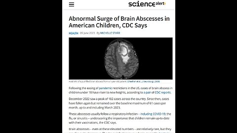 Abnormal Surge of Brain Abscesses in American Children, CDC Says