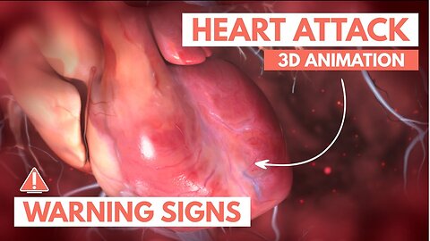 Recognizing a heart attack | 3D Animation 2023 Latest technology treatments symptoms / Consequences