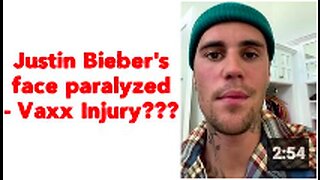 Justin Bieber's face paralyzed - Vaxx Injury???