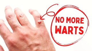 Your Wart Will Fall Off Quickly After Applying This Mixture