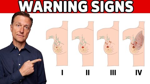 6 Early Warning Signs of Breast Cancer