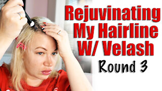 Rejuvenate My Hairline with Velash and my Dr.Pen | Code Jessica10 saves you $$$