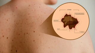 How To Tell If Your Mole is Cancerous? Use This Simple ABCD Test!
