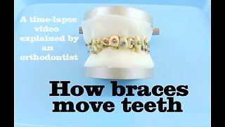 How braces move teeth