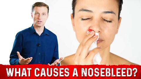 What Causes Nosebleeds/Epistaxis – 8 Common Causes of Nose Bleeding – Dr.Berg