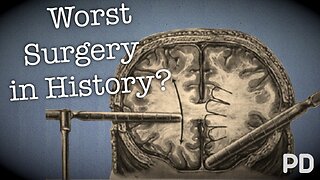 The Dark side of Science: The Lobotomy, the worst surgery in history?