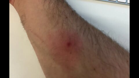 So... I got a spider bite, and things went down hill from there...