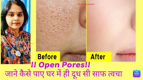 Home remedies for open pores | open pores का घरेलू इलाज #drminakshisingh