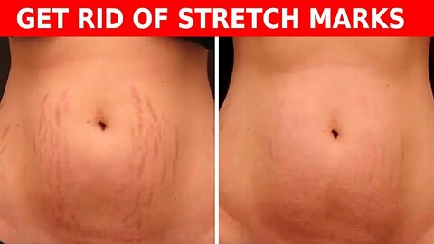 Make Stretch Marks Disappear With These Easy Steps