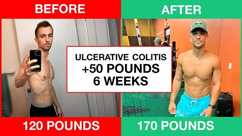 Shayne’s Ulcerative Colitis Treatment Plan || Ulcerative Colitis Symptoms Relief In 30 Days