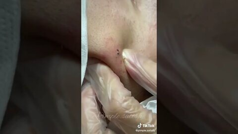 Crazy deep blackheads removal 😬🫣 #blackheadremoval #blackhead #blackheads #blackheadsremoval #fyp