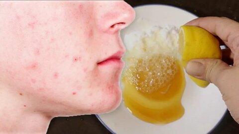 How to Get Rid of Acne, Stains and Pimple Marks Naturally