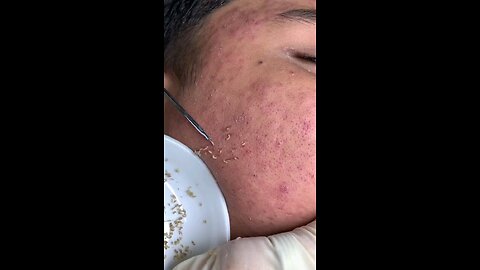 Blackheads episode 66