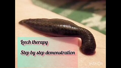 Leech Therapy