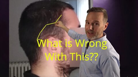 Too Thin for A Hair Transplant? Hair Transplant Consultations #4