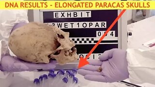 DNA Results in - Elongated Skulls, Nephilim, Giants & 6 Fingers - Alien Origin - LA Marzulli