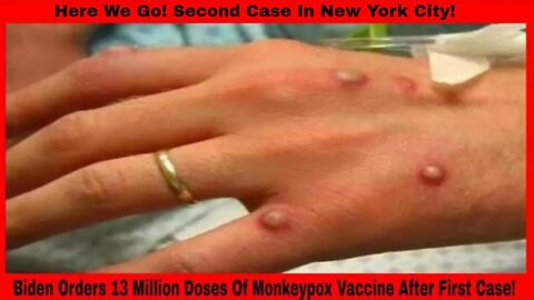 Biden Orders 13 Million Doses Of Monkeypox Vaccines? Second Case In New York!