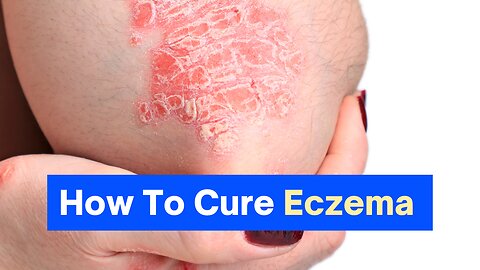 Cure Eczema at home