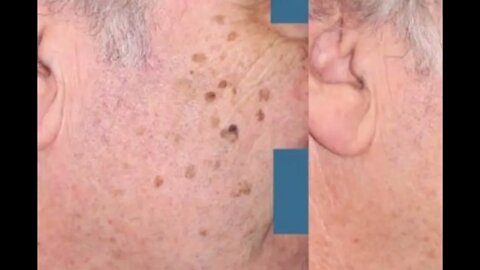 AGE SPOTS REMOVAL