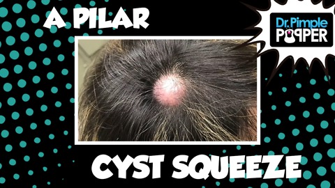 Don't Be Cyst Averse...Embrace the Popping