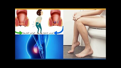ultimate natural & effective remedy for constipation & anal external & internal hemorrhoids in week!