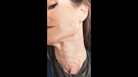 Mesotherapy in my neck with Miracle L Natural Kaos Skincare