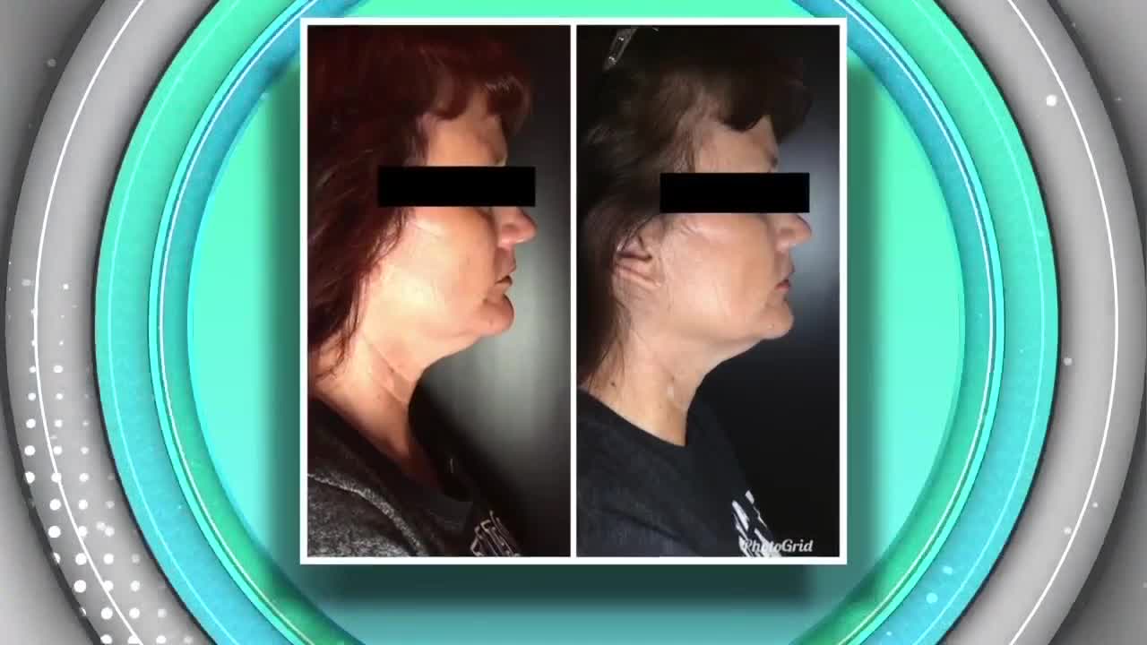 Ageless Expressions - Kybella Weight Loss