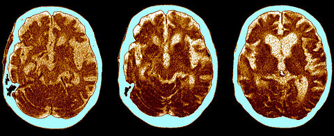 Unraveling Alzheimer's Resistance: What Makes Some People Immune?