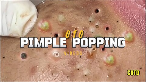Satisfying Pimple Popping Videos 010