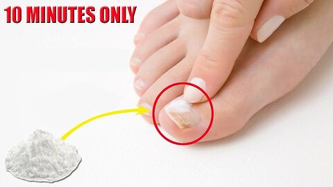 TREAT TOENAIL FUNGUS FAST AT HOME WITH THIS
