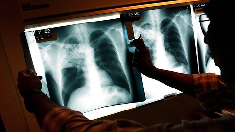 FDA Approves New Treatment For Drug-Resistant Forms Of Tuberculosis