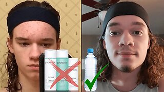 How To Clear Up Acne Naturally.. (What They Don't Tell You About Skincare!)