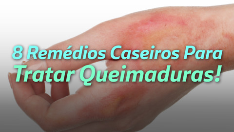 8 Remédios Caseiros Para Tratar Queimaduras!