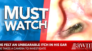 He Felt An Unbearable Itch Inside His Ear So He Takes A Camera To Investigate. Then It Pops Out.