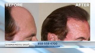 Dr. James Deyarman explains why stem cell treatments may work for you instead of hair transplants